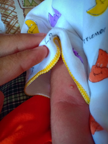 jerawat pada bayi