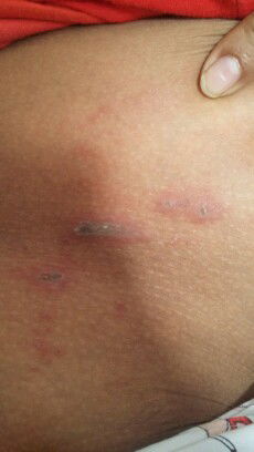 lecet di kulit solusinya.?