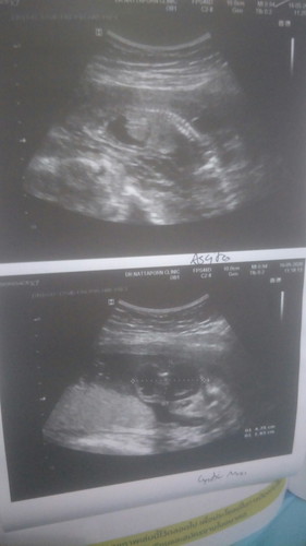 ลูกในครรภ์มีถุงน้ำ