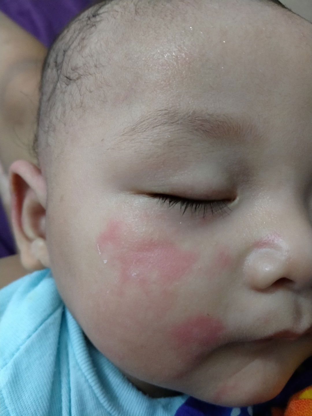 merah2 di kulit wajah dan tangan bayi