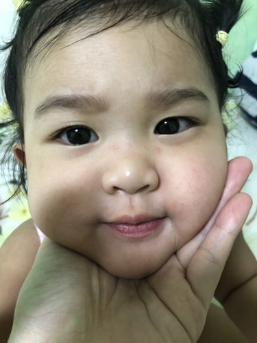 Hi mga momshie’s ask ko lang po kung ganito po ba yung bungang araw?