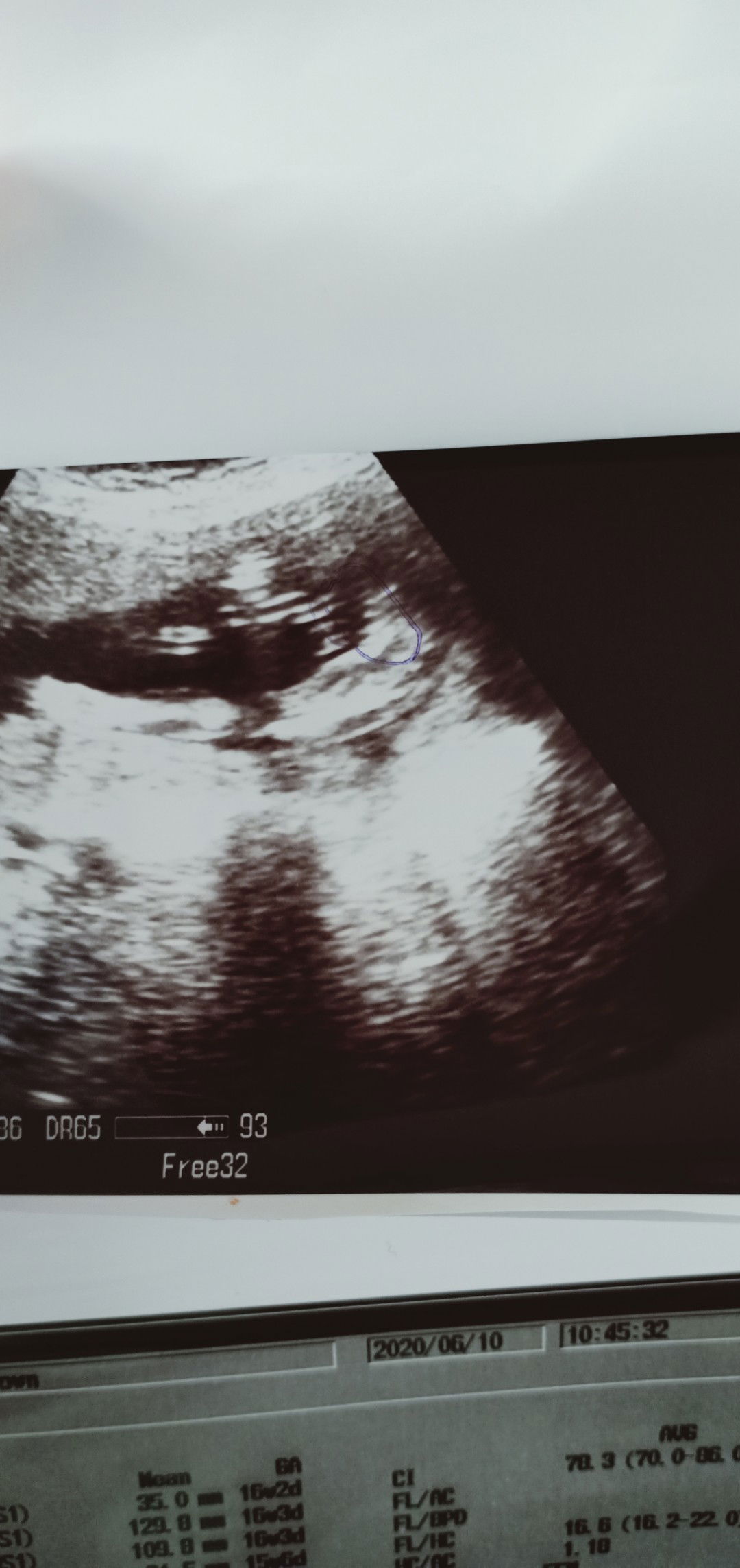 อัลตร้าซาวด์ดูเพศลูกตอน17 สัปดาห์