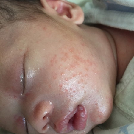 ลูกเป็นผื่นที่หน้าลูกบ้านไหนเป็นบ้างคะ