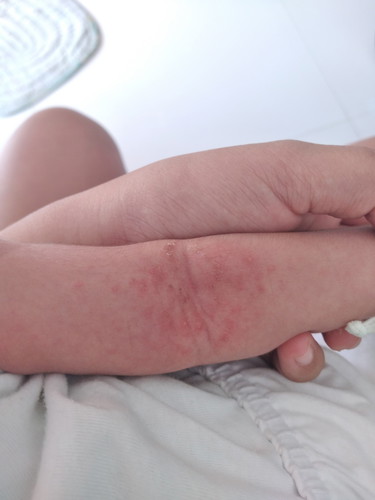 Rashes po ba?