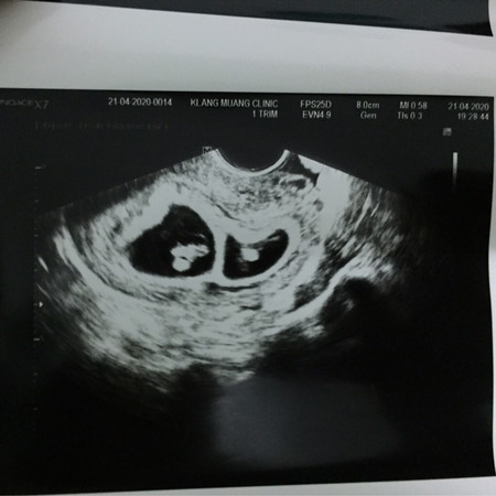 ท้องได้ 11 week