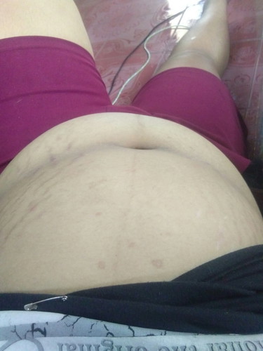 เราท้อง21วีค ท้องแตกลายขนาดนี้ปกติมั้ย