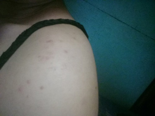 rashes