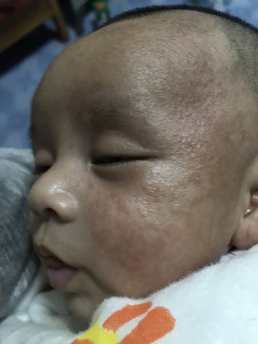 น้องเป็นผื่นแบบนี้เกิดจากอะไรค่ะ