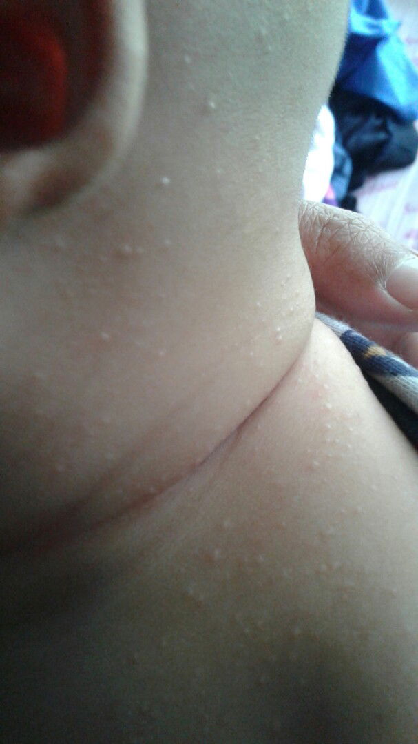 bintik bintik di leher