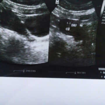 Kandungan Usia 4minggu Udah Positif Hamil Apa Belum Ya Soalnya Masih Ragi2 Nihj