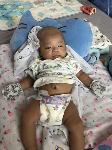 สะดือน้องโป่ง แบบนี้อันตรายมั้ยค่ะ