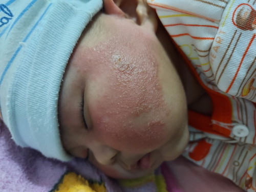 กลากน้ำนม