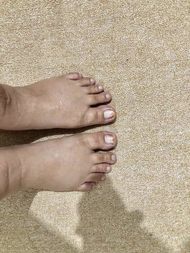 Kaki bengkak di 33 minggu