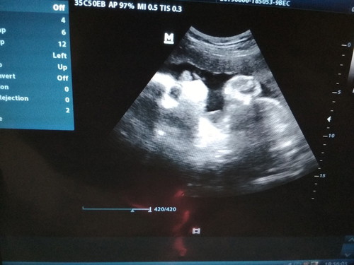 32week