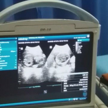 izin bertanya tentang usg