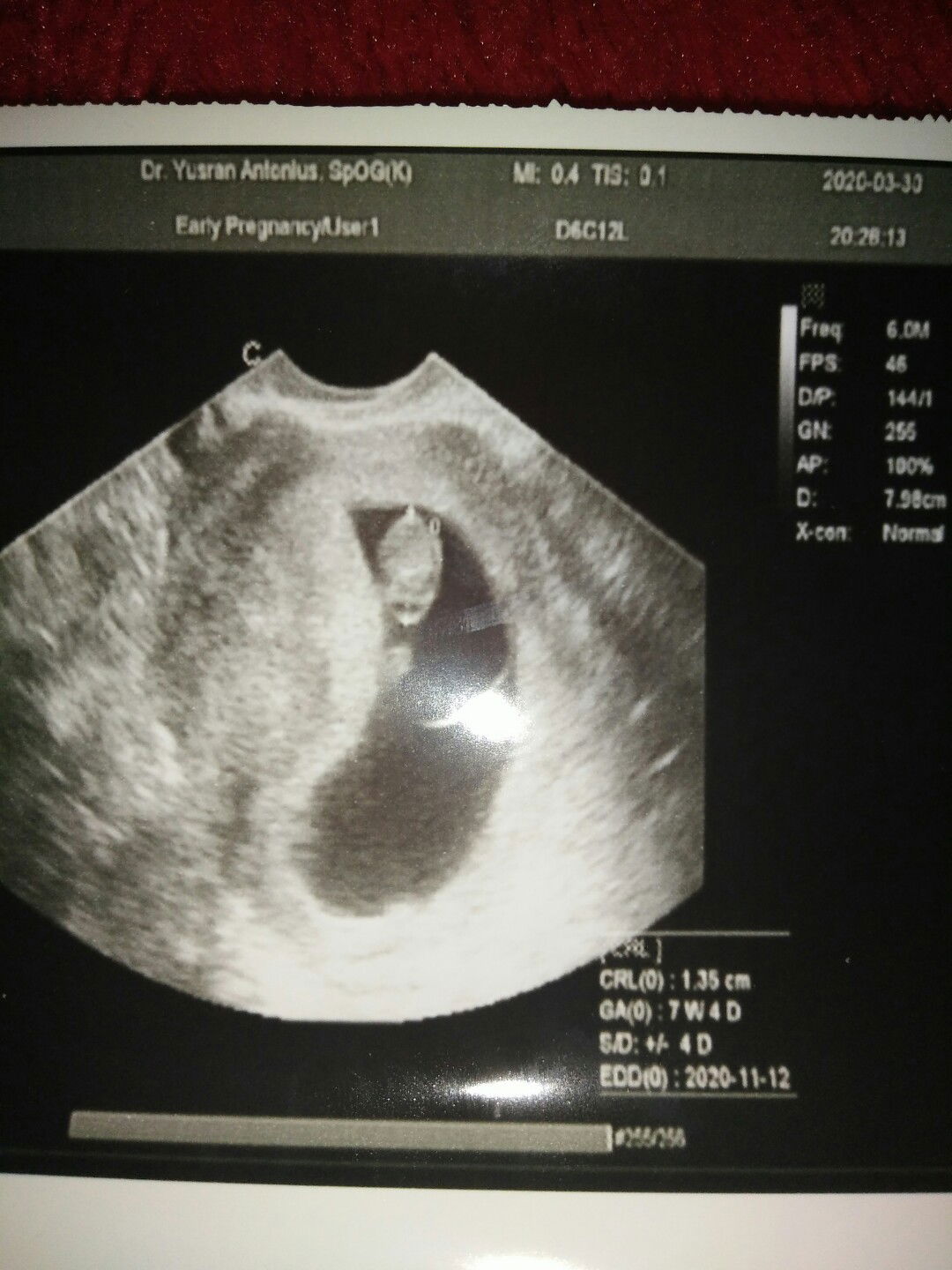 Janin tidak betkembang