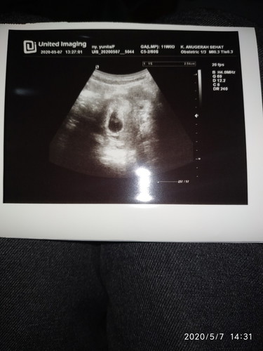 Janin tidak berkembang