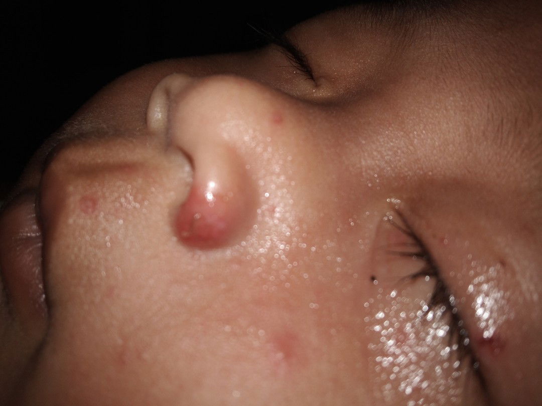 bintik merah sekitar hidung wajah dan bawah dagu