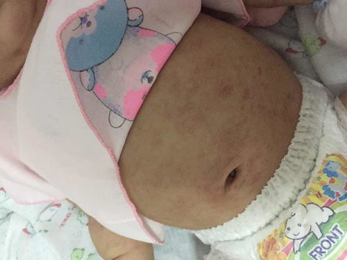 ผื่นแดงตามตัว