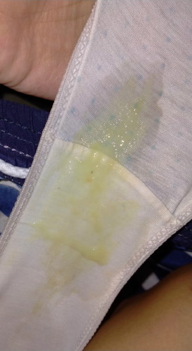 discharge, need answer tia