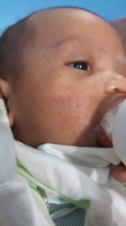 BABY ACNE