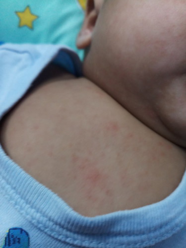 RASH