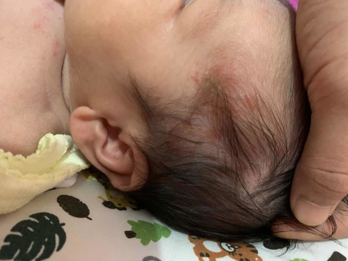 Ada yg tau ga bun ini kenapa. Bisa minta info nya ga gimana cara ngatasin nya. Atau si kecil ada alergi apa