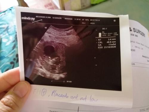 Pregy 11weeks