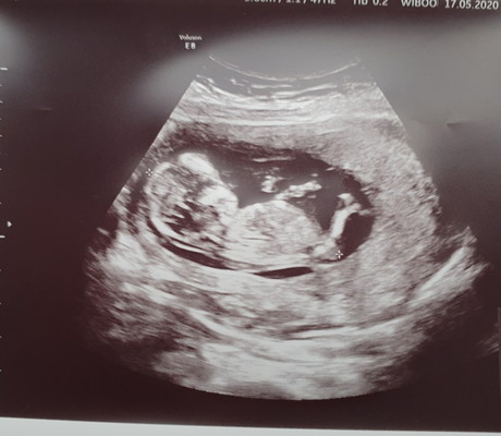 ตั้งครรภ์ 12 วีคนิดๆ