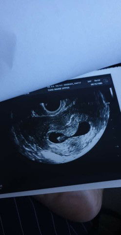 contractions at 8 weeks.