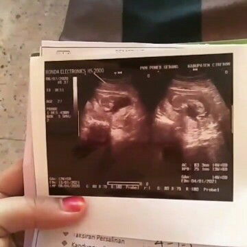 Banyakin minum air putih sebelum  usg