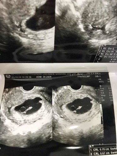 Missed or Spontaneous Abortion