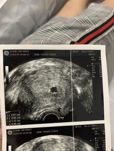 6วีคอัลตราซาวด์ไม่เจอตัวอ่อน