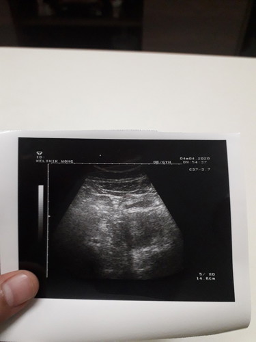 scan tp tk nampak lg baby