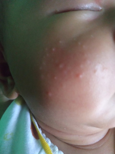 pipi bayi bruntusan