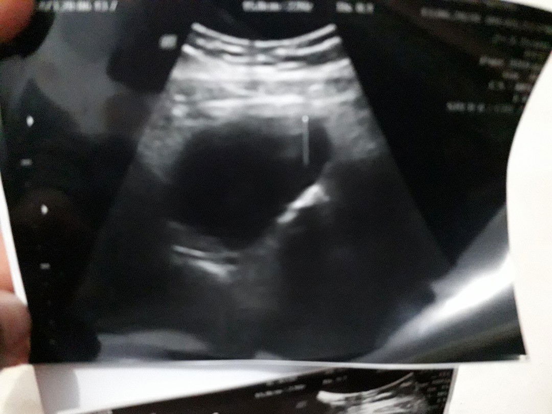 bayi mati didalam kandungan