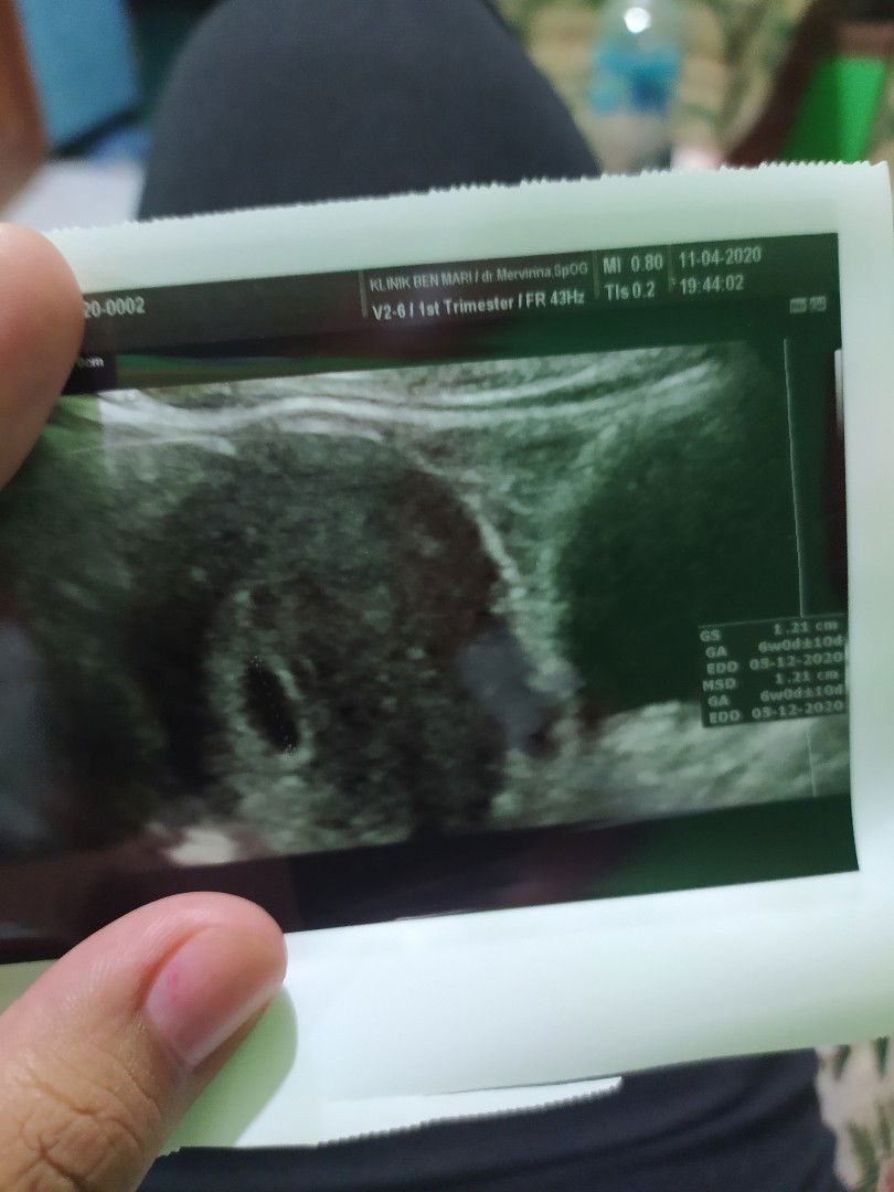 hasil usg hamil usia 7 minggu menurut bidan