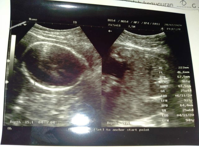 usia kandungan 26 minggu