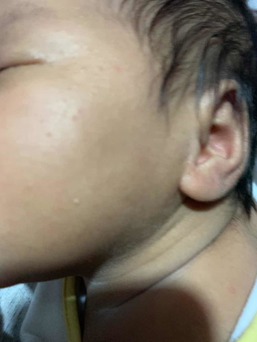 ผื่นแบบนี้เป็นผื่นอะไร