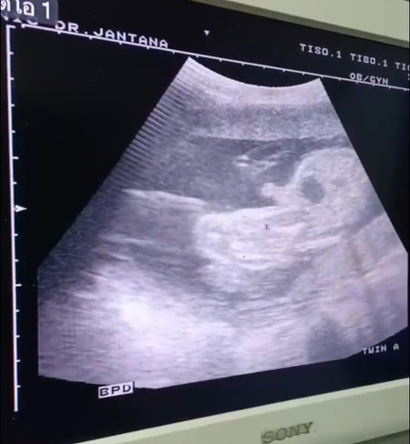 แอบคิดว่าได้ลูกสาว หลายคนทักว่าลูกสาวแน่นอน แต่เมื่อวานไปซาวด์มา หมอบอกผู้ชาย แม่น้ำตาจะไหล