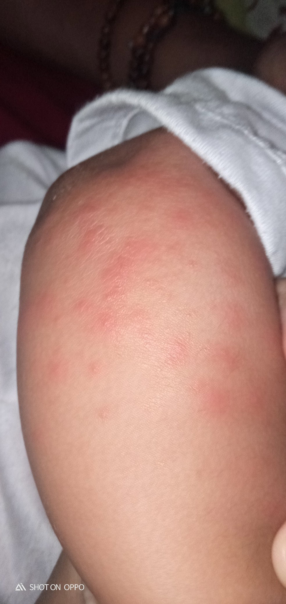 Obat biang kringat apa bun?