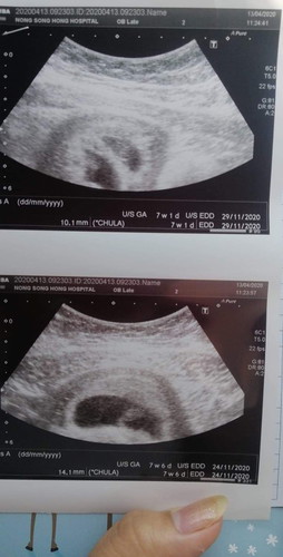 อัลตร้าซาวด์ครั้งแรกค่ะ