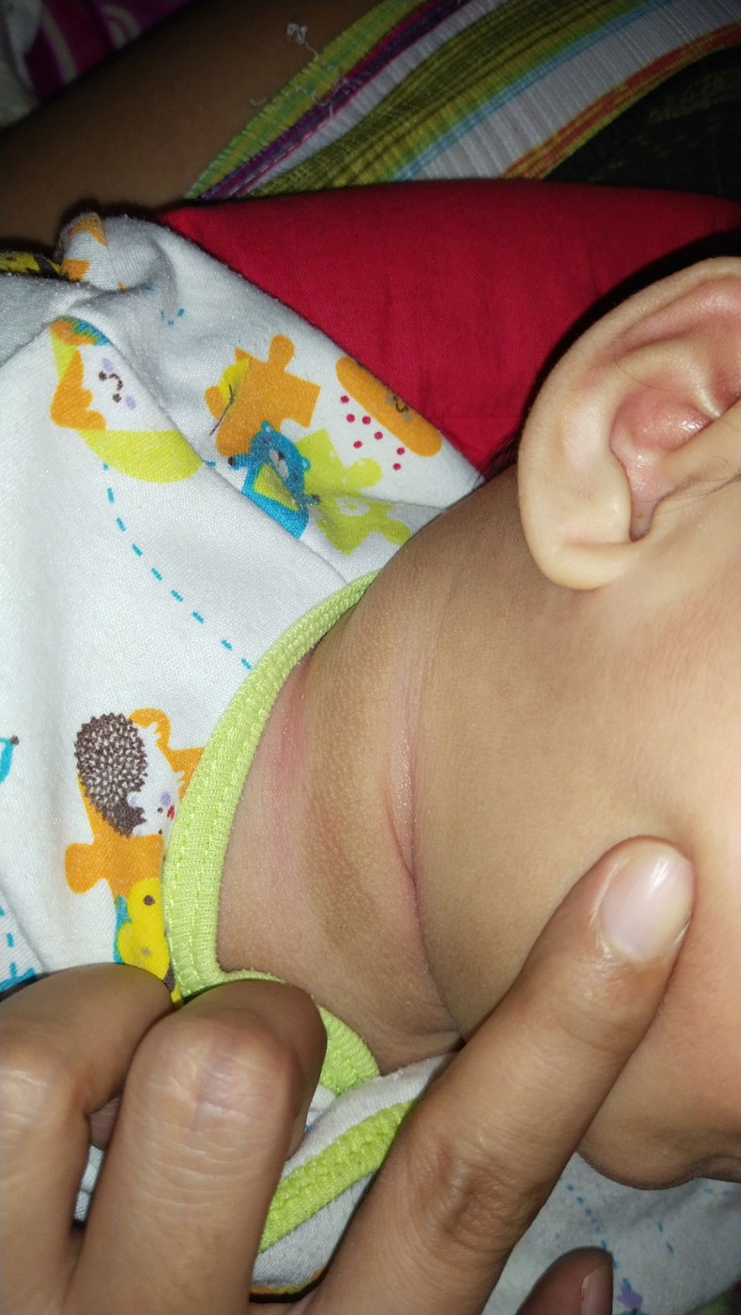 hiperpigmentasi kulit