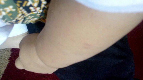 Bintik merah tanpa demam