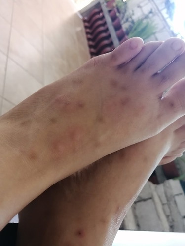 Bed bug bites