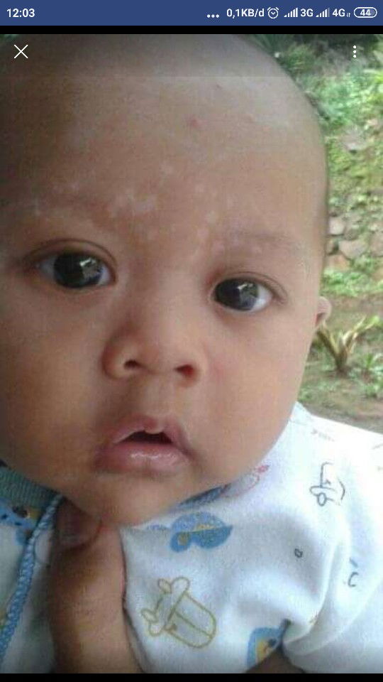 Obat Untuk Panu Pada Bayi