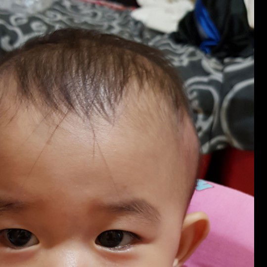 ada benjolan dikepala bayi tapi bukan karena terbentur
