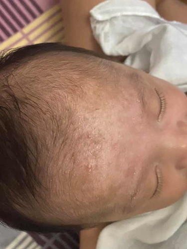 Hello, first time mom ask ko lang kung ano po yung white sa may noo ni baby nung isearch ko kasi sa net same ng photo nia yung skin problem which is an