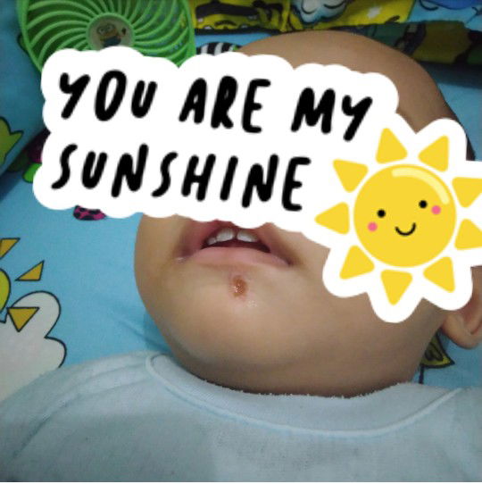 Obat Luka/gatel. Baby Menuju 11m