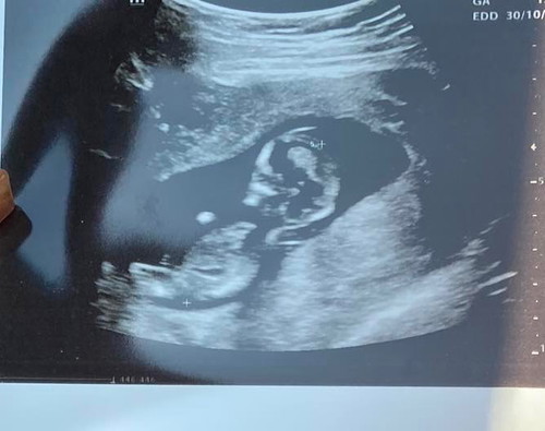 อายุครรภ์12สัปดาค่ะ